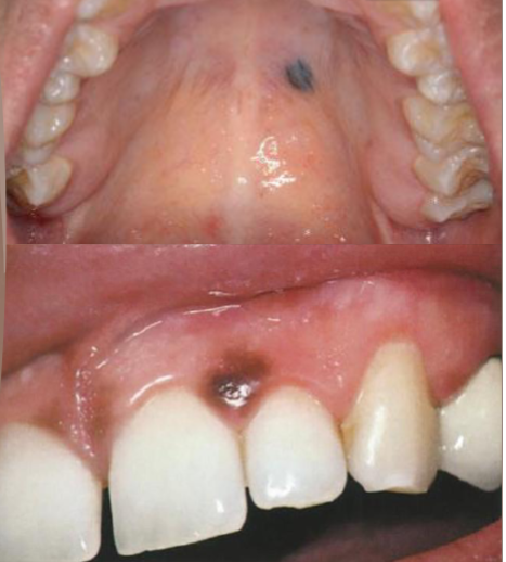 <p>developed during childhood and YA, located on the skin above the waist and intraorally on the hard palate or gingiva, but can occur anywhere</p>