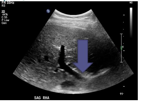 <p>Measure the portal vein diameter where it crosses anterior to the IVC during quiet respiration.</p><p>Want to sample as far outside of the liver as we can see it</p>