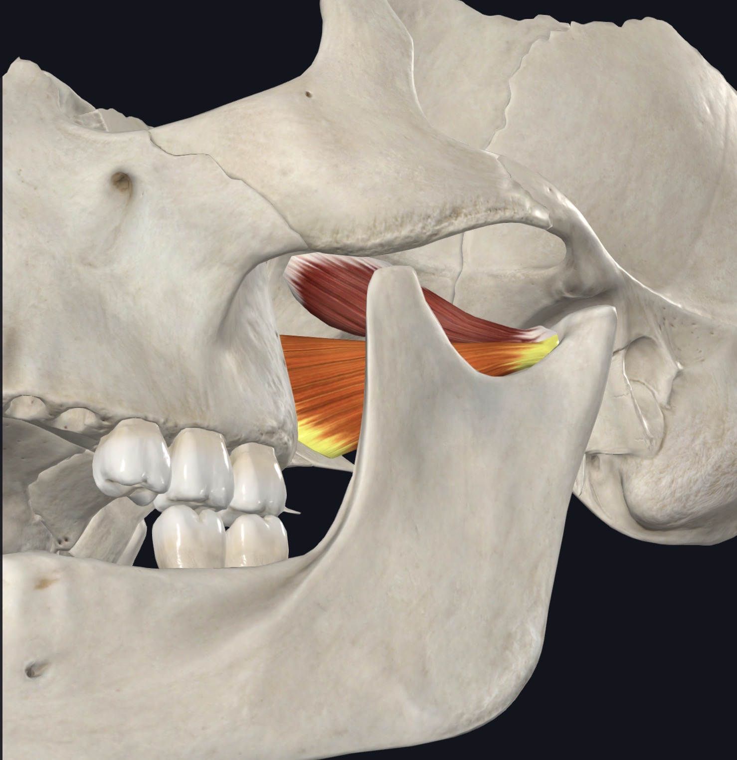 <p>Lateral pterygoid Origin</p>
