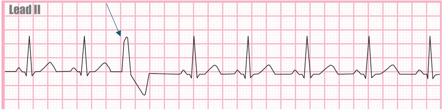 <p>looking at the picture, what kind of dysrhythmia is the arrow pointing to</p>