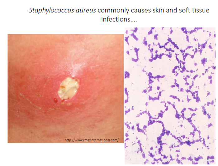 <p>Staphylococcus aureus commonly causes skin and soft tissue infections</p>