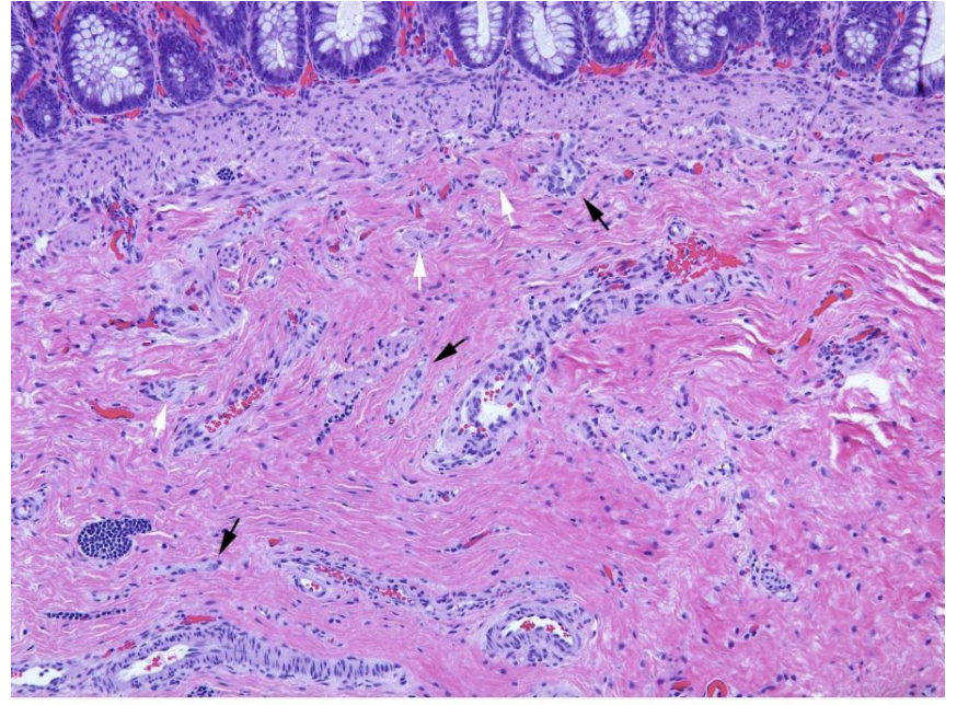<p>in hirschsprung disease</p>
