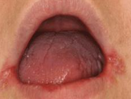 <p>appears as <span style="color: red;">white ulcerated patches</span> in the corners of the mouth</p><ul><li><p>associated with;</p><ul><li><p>px with <strong>occlusal vertical dimension problems</strong></p></li><li><p>edentulous px without appropriate prosthodontic support</p></li><li><p>px with dentures having inadequate:</p><ul><li><p><strong>vertical dimension, “freeway” space</strong></p></li></ul></li></ul></li><li><p>Chronic moisture at the corners of the mouth provides an optimal environment for <strong>Candida overgrowth</strong>.</p></li><li><p>clinical findings:</p><ul><li><p><strong>erythema</strong></p></li><li><p><strong>white patches</strong> at the commissures often <strong>bilateral</strong></p></li><li><p>often accompanied by <strong>Staphylococcus aureus</strong> infection.</p></li></ul></li><li><p>nutritional deficiencies:</p><ul><li><p>folic acid deficiency</p></li><li><p>iron deficiency</p></li><li><p>riboflavin deficiency</p></li><li><p>thiamine deficiency</p></li><li><p>vitamin B12 deficiency</p></li></ul></li><li><p>tx:</p><ul><li><p>nystatin oral suspension</p></li></ul></li></ul><p></p>
