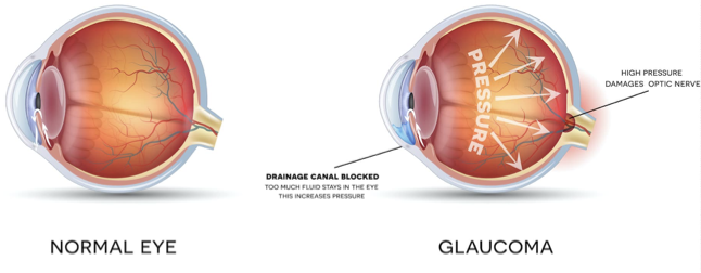 <ul><li><p><span>Normally, the anterior chamber of the eye is moderately pressurized which helps the eye maintain its shape</span></p></li><li><p><span>When there is insufficient drainage of the anterior chamber of the eye (for example with aging which is associated with a loss of drainage cells) pressure begins to increase</span></p></li><li><p><span>Bottle-neck effect</span></p></li></ul><p></p>