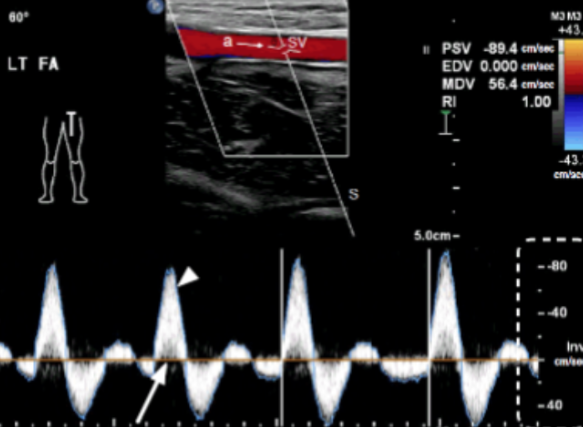 <p>Does the image show pulsatile or phasic flow?</p>