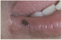<p>an area that is distinguished by a color different that the surrounding tissue, typically flat and non-protruding. Ex. freckle</p>