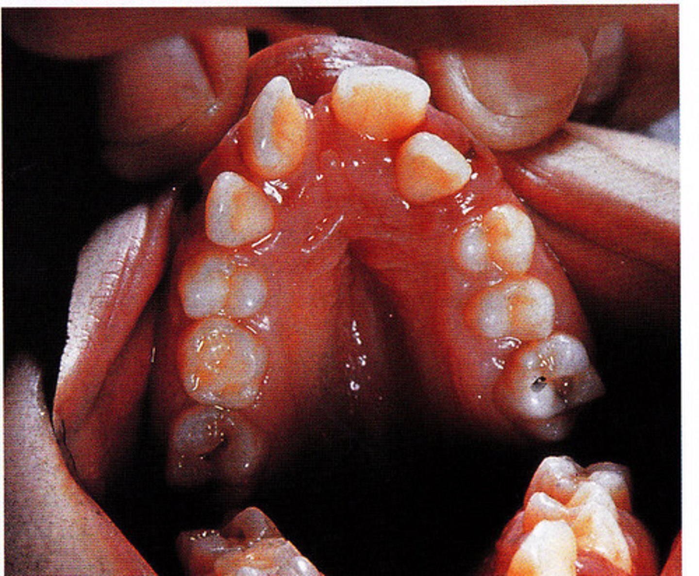 <p><br>-markedly high-arched palate and malpositioned teeth in a patient with mandibulofacial dysostosis</p><p>-also known as treacher collins syndrome</p><p>-results in a dysmorphic face, including downward sloping of the palpebral fissures.</p><p>-mouth appears fishlike</p>