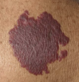 <p><span>Vascular lesion involving capillaries that produces an irregular, flat or raised patch ranging from light red to dark purple (e.g., congenital vascular malformation of capillaries).</span></p>