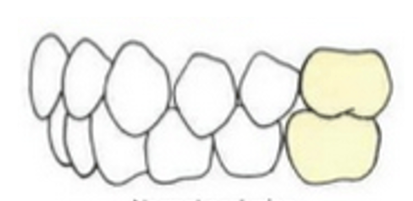 <p>When the <strong>MB cusp</strong> of the maxillary 1st molar falls into the <strong>B developmental groove</strong> of the 1st mandibular molar</p>
