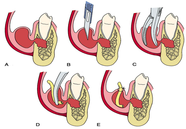 <p>1. Anesthesia • Preferred: Regional nerve block • Alternative: Infiltration </p><p>2. Stab Incision • At the site of maximum swelling • In MX: inferiorly for maximum gravity-dependent drainage • No more than 1 cm in length. • Avoid frenum and mental nerve</p><p>3. Insertion of Hemostat or Sinus Forceps • If pus is not encountered, deepen the surgical site carefully with sinus forceps to avoid damaging vital structures. • Steps • Closed forceps are pushed through the deep fascia towards the pus collection. • Once the abscess cavity is entered, the forceps are opened parallel to vital structures. • Pus drains along the sides of the forceps. • Entire cavity is explored for additional loculi.</p><p>4. Placement of Drain • A rubber drain is inserted into abscess cavity. • External part is secured to the wound margin. • Drain is left for at least 2–5 days. • Purpose of Drain: • Allows continuous drainage of contents. • Maintains the opening for drainage. • Enables irrigation and debridement. • Commonly used drain: • ¼ inch sterile Penrose drain (most common) • Alternative: sterile glove or rubber dam </p><p>5. Dressing • For extraoral incisions to protect the wound</p>