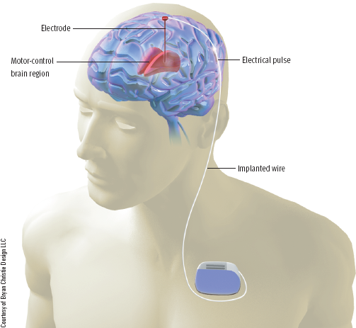 <p>A procedure where a thin electrode is surgically implanted into the brain and connected to a pulse generator to treat motor disturbances or depression.</p>