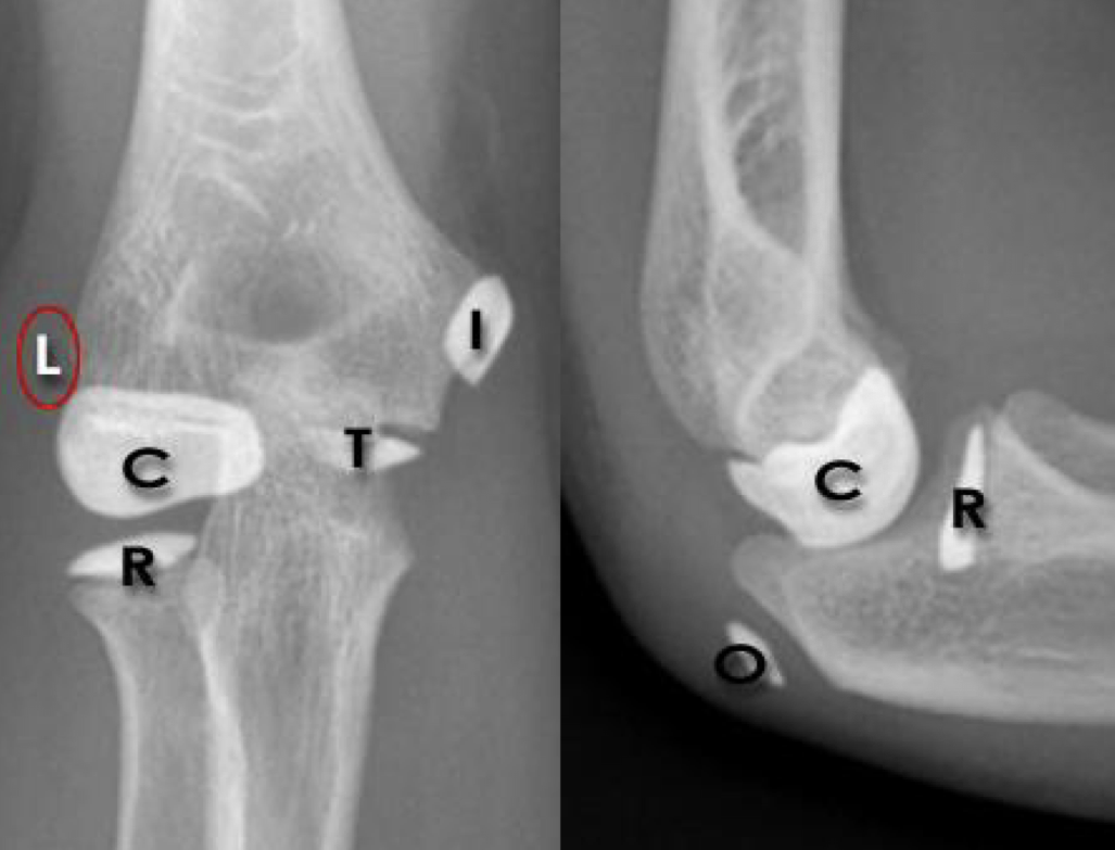 <p>Ossification centers of the elbow (CRITOE + 1, 3, 5, 7, 9, 11)</p>
