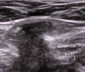 <ul><li><p>Occurs medial to IEV</p></li><li><p>Acquired hernia</p></li><li><p>Affects elderly men w/ weakened transversalis fascia</p></li><li><p>Appear immediately when standing</p></li></ul><p></p>
