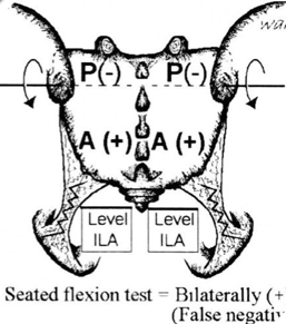 <ul><li><p>motion decreased bilaterally</p></li><li><p>sacrum extends</p><ul><li><p>but is restricted in flexion </p></li></ul></li><li><p>spring test → postive </p></li></ul><p></p>