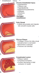 <p>Hardening and narrowing of the arteries due to buildup of cholesterol plaques</p>