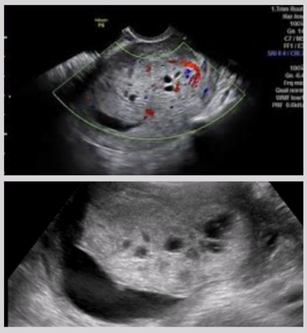 <ul><li><p><span style="background-color: transparent;">Characterized by presence of numerous cystic areas within enlarged placenta&nbsp;</span></p></li><li><p><span style="background-color: transparent;">Not considered part of GTD spectrum&nbsp;</span></p></li><li><p><span style="background-color: transparent;">Associated w/ partial mole and paternal triploidy</span></p></li><li><p><span style="background-color: transparent;">Simple hydropic degeneration in first trimester → increased risk of fetal demise</span></p></li></ul><p></p>