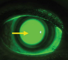 <p>fluorescent pattern of a tight contact lens.</p>