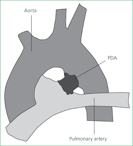 <p>Ductus arteriosus</p>