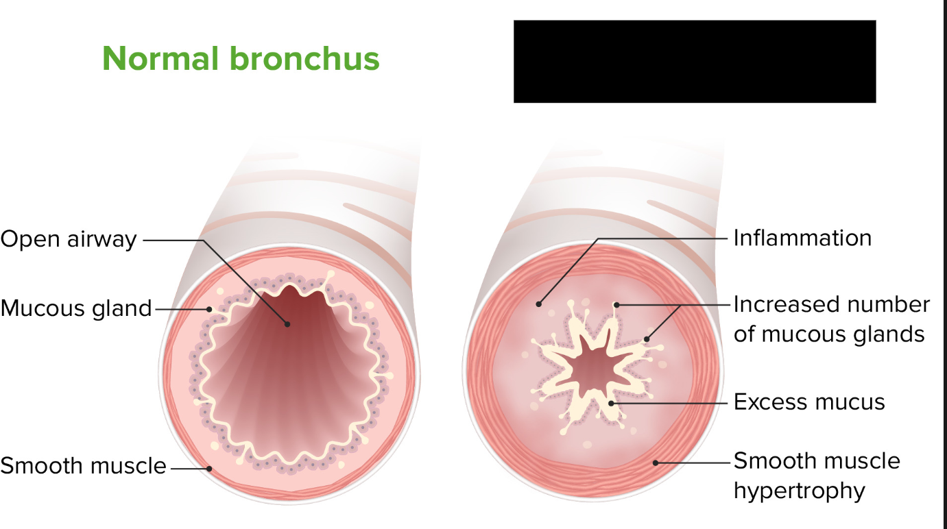 <p><span style="background-color: transparent;">A condition that affects the bronchi and bronchioles (small tubes that allow for the passage of air in and out of the lungs). The airways become narrowed and blocked by mucus, limiting airflow.</span></p>