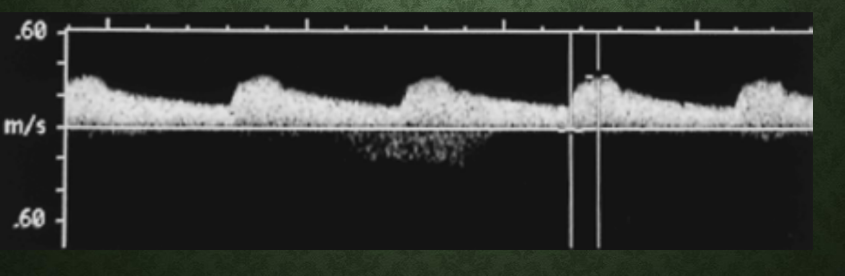<p>What is tardus parvus?<br>→ Waveform slow to rise and fall</p><p>What does tardus parvus indicate?<br>→  sign of Proximal obstruction</p><p>What happens to acceleration time in tardus parvus?<br>→ Prolonged/long acceleration time</p>