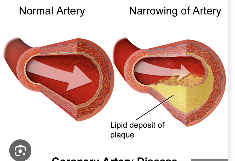 <ul><li><p><strong><mark data-color="rgba(0, 0, 0, 0)" style="background-color: rgba(0, 0, 0, 0); color: inherit;">a condition where plaque builds up in the arteries supplying blood to the heart, reducing blood flow and oxygen</mark></strong><span>.</span></p></li><li><p><span>sensitive to stress</span></p></li><li><p><span>specific disease </span></p></li></ul><p></p>