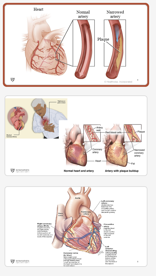 <p><span>Plaque rupture or erosion with thromboses (true medical emergency)</span></p><p></p><p style="text-align: left;"><span>1. ST Elevation Myocardial Infarction (STEMI)</span></p><ul><li><p><span>Q wave M</span></p></li><li><p><span>Transmural MI (full thickness injury)</span></p></li></ul><p style="text-align: left;"></p><p style="text-align: left;"><span>2. Non-ST Elevation MI (NSTEMI)</span></p><ul><li><p><span>non Q wave MI</span></p></li><li><p><span>Subendocardial MI (partial thickness injury)</span></p></li></ul><p style="text-align: left;"></p><p style="text-align: left;"><span>&nbsp; 3. Unstable Angina</span></p>