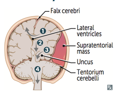 <p>Brain shifts from areas of high intracranial pressure to low intracranial pressure</p>