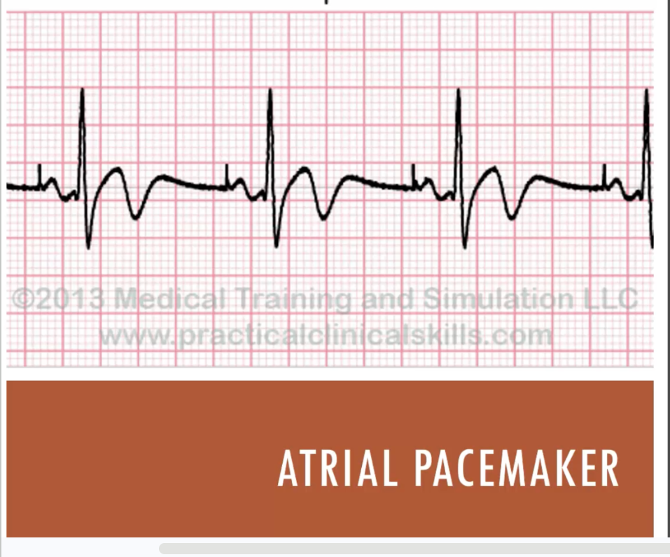 <p>atrial pacemaker</p>