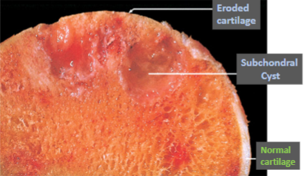 <p>Osteoarthritis</p>