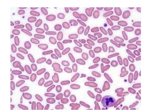 <p>What is hereditary elliptocytosis</p>