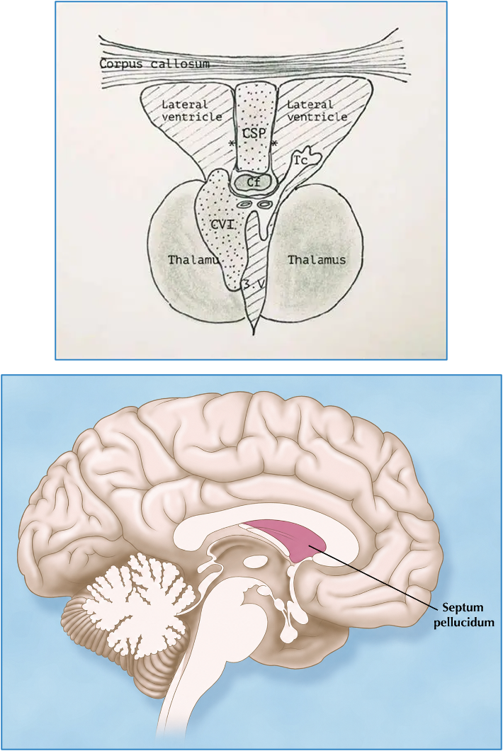 <p><strong>septum pellucidum:</strong></p><ul><li><p>small structure that lies just inferior to corpus callosum, and in b/w the anterior aspects of lateral ventricles</p></li></ul><p><strong>cavum septum pellucidum (CSP):</strong></p><ul><li><p>small, fluid filled space within septum pellucidum</p><ul><li><p>we focus more on CSP on u/s because it’s visualized more clearly</p></li></ul></li></ul><p>—</p><p><strong>sono app:</strong></p><ul><li><p>anechoic, box-shaped structure in middle of brain, anterior to thalamus</p></li><li><p>seen in TRV thalamic and oblique cerebellar views</p></li><li><p>CC anterior, superior to CSP</p></li><li><p>often there’s a fine hypoechoic ‘U’ shaped structure which represents the anterior leaflets of the CC </p><ul><li><p>if not visualized, there’s a risk of a brain abnormalities</p></li></ul></li></ul><p></p>