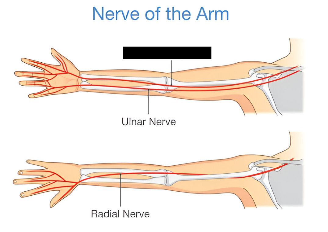 <p>a major peripheral nerve originating from the brachial plexus<span>. It runs down the arm, forearm, and through the carpal tunnel in the wrist. It is responsible for the motor control of most forearm flexors and thumb movements, as well as sensory innervation to the palm, thumb, index, middle, and half of the ring finger. </span><br></p>