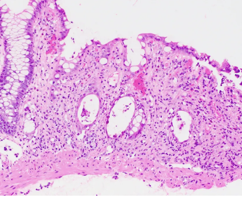 <p>1) - ou + de 100 jours </p><p>2) moelle > > organes solides </p><p>3) </p><ul><li><p>Apoptoses</p></li><li><p>Crypt dropout (photo) </p></li><li><p>agrégats de cellules neuroendocrines (plus résistantes)</p></li><li><p>inflammation légère à modérée </p></li></ul><p>4) </p><ul><li><p>Colon : au moins 6 apoptoses pour 10 cryptes adjacentes</p></li><li><p>estomac : au moins 2 poptoses pour 10 cryptes adjacentes</p></li></ul><p></p><p>5) </p><ul><li><p><span style="font-family: "Times New Roman"; line-height: normal; font-size: 7pt;">&nbsp; </span><1 apoptose/10 crypte = négatif</p></li><li><p class="MsoListParagraphCxSpMiddle"><span style="font-family: "Times New Roman"; line-height: normal; font-size: 7pt;">&nbsp;&nbsp; </span>1-6 apoptoses/10 cryptes = indéterminé</p></li><li><p class="MsoListParagraphCxSpLast"><span style="font-family: "Times New Roman"; line-height: normal; font-size: 7pt;">&nbsp;&nbsp;&nbsp; </span>>6 apoptoses/10 cryptes et pit dropout</p></li></ul><p></p><p>6 ) </p><ul><li><p>Virus (adenovirus, CMV)</p></li><li><p>Mycofenolate mofetil</p></li><li><p>Checkpoint inhibitors </p></li><li><p>Préparations coliques</p></li><li><p>chimiothérapie </p></li></ul><p></p>