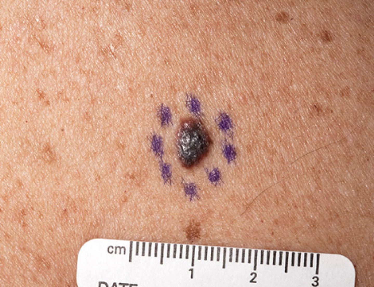 <p>a small raised skin or mucosal lesion refers to lesions less than 1cm</p>