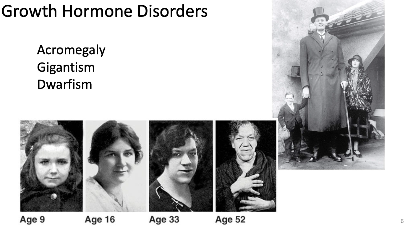 <p>Acromegaly</p><ul><li><p>Growth hormone released in adulthood thickens cartilage but do not grow taller</p></li></ul><p>Gigantism</p><ul><li><p>Excess growth hormone during childhood</p></li></ul><p>Dwarfism</p><ul><li><p>Decreased Growth hormone in childhood</p></li></ul><p>*Usually caused by pituitary tumor which hyper secretes</p><p></p>