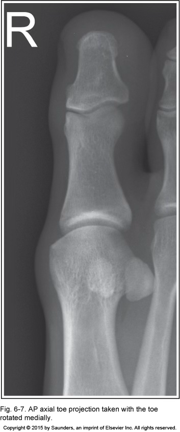 <p>AP axial toe</p>