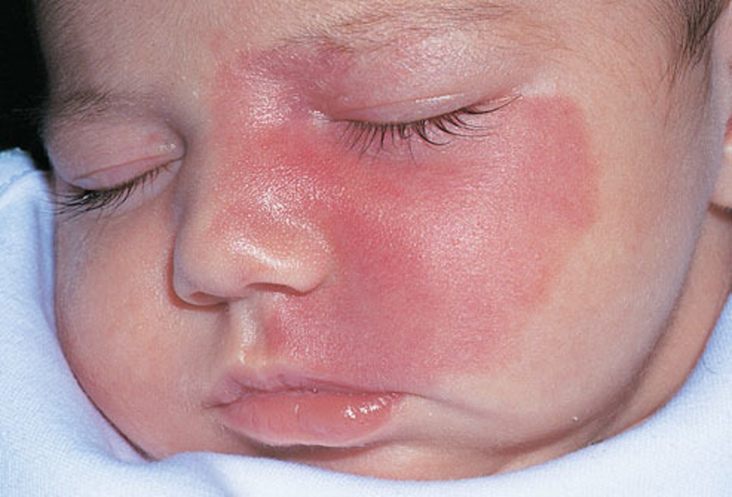 <p>low flow capillary malformation that can occur anywhere on the body</p>