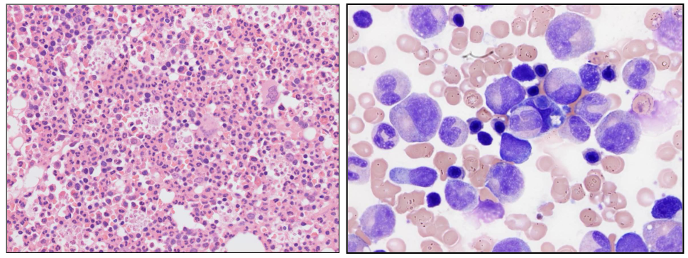 <p>- BM responds by increasing neutrophil production</p><p>- Reactive granulocytic hyperplasia with "left shift"</p><p>- Increased BM macrophages</p><p>.</p><p>- there are no fat spaces in this bone marrow this is all granulocytic hyperplasia (increase in granulopoiesis)</p><p>- on the right we see cells on aspirate and majority of them are of the granulocytic lineage</p>