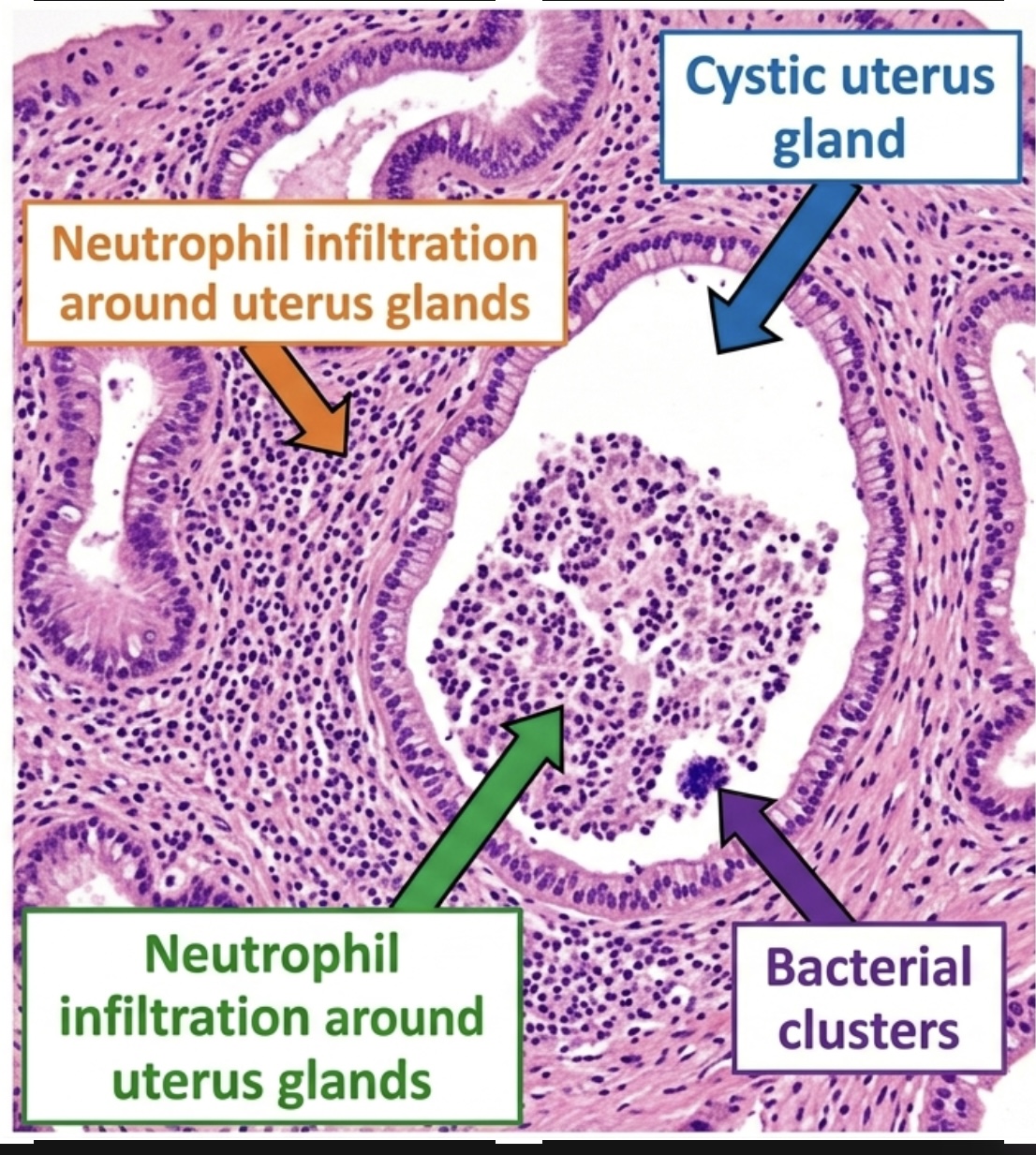 <p>metritis purulente cystica , uterus</p>