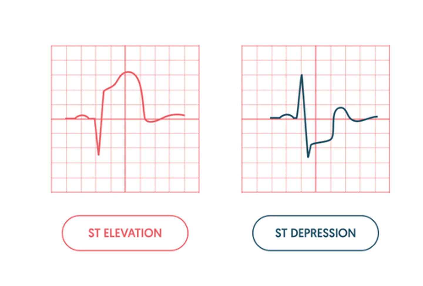 <p>B) NSTEMI usually presents with ST depression (typically but not all the time, NSTEMI = non-ST-elevation) on EKG and does not indicate the exact date or time of occurrence and does not require immediate intervention</p>
