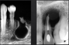 <p>How are these lesions described in terms of periphery?</p>