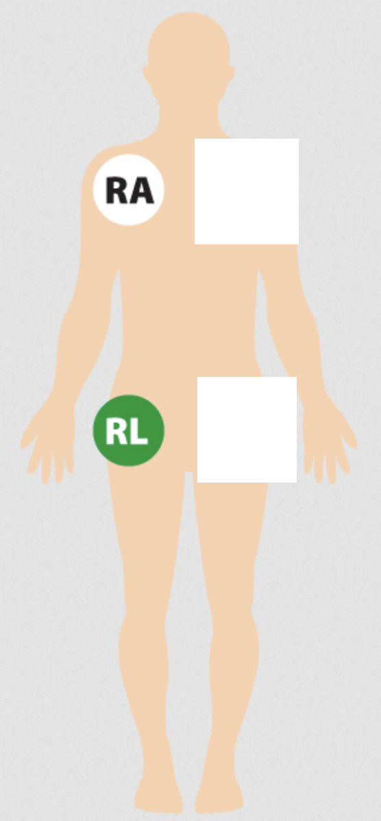 <p>right limb lead placement - for all EKGs</p>