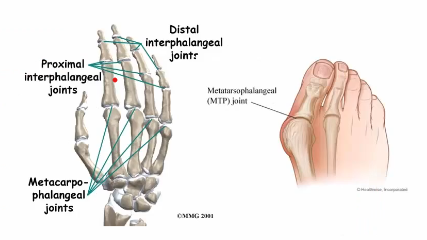 <p>Maise</p><p>Fatigue</p><p>SYMMETRICAL pattern of joint pain, stiffness, swelling and redness</p><p>Involvement of MCP, PIP & MTP joints (too long to list real names)</p><p>NOT usually the joints closest to your nails (that’s more osteoarthiritis)</p><p>Morning stiffness</p><p>Weight loss</p><p>Fever</p><p>Depression</p>