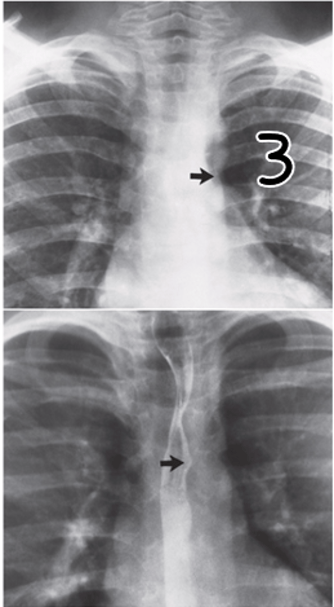 <p>D. Coarctation</p>