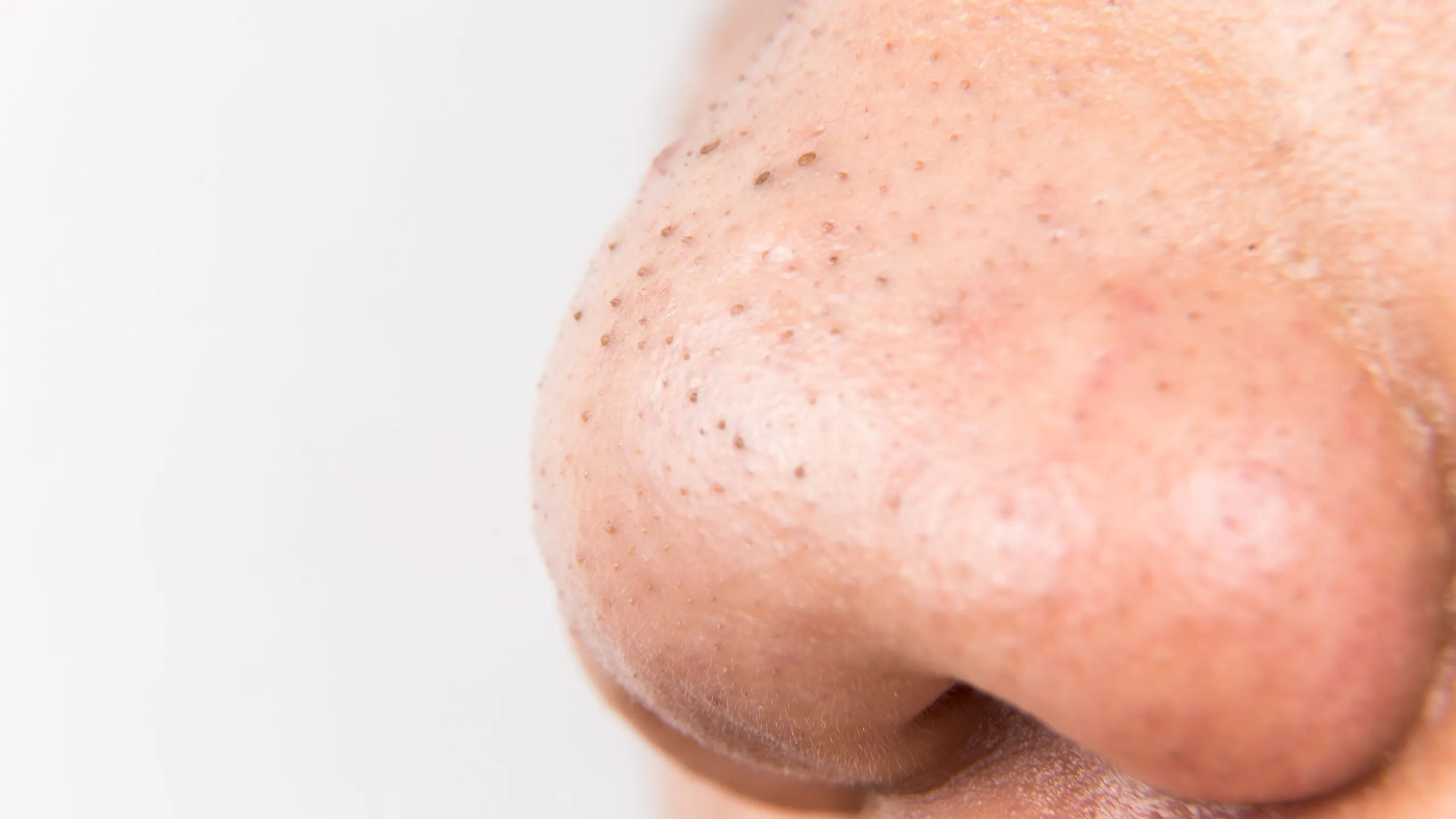 <p>Blackhead</p>