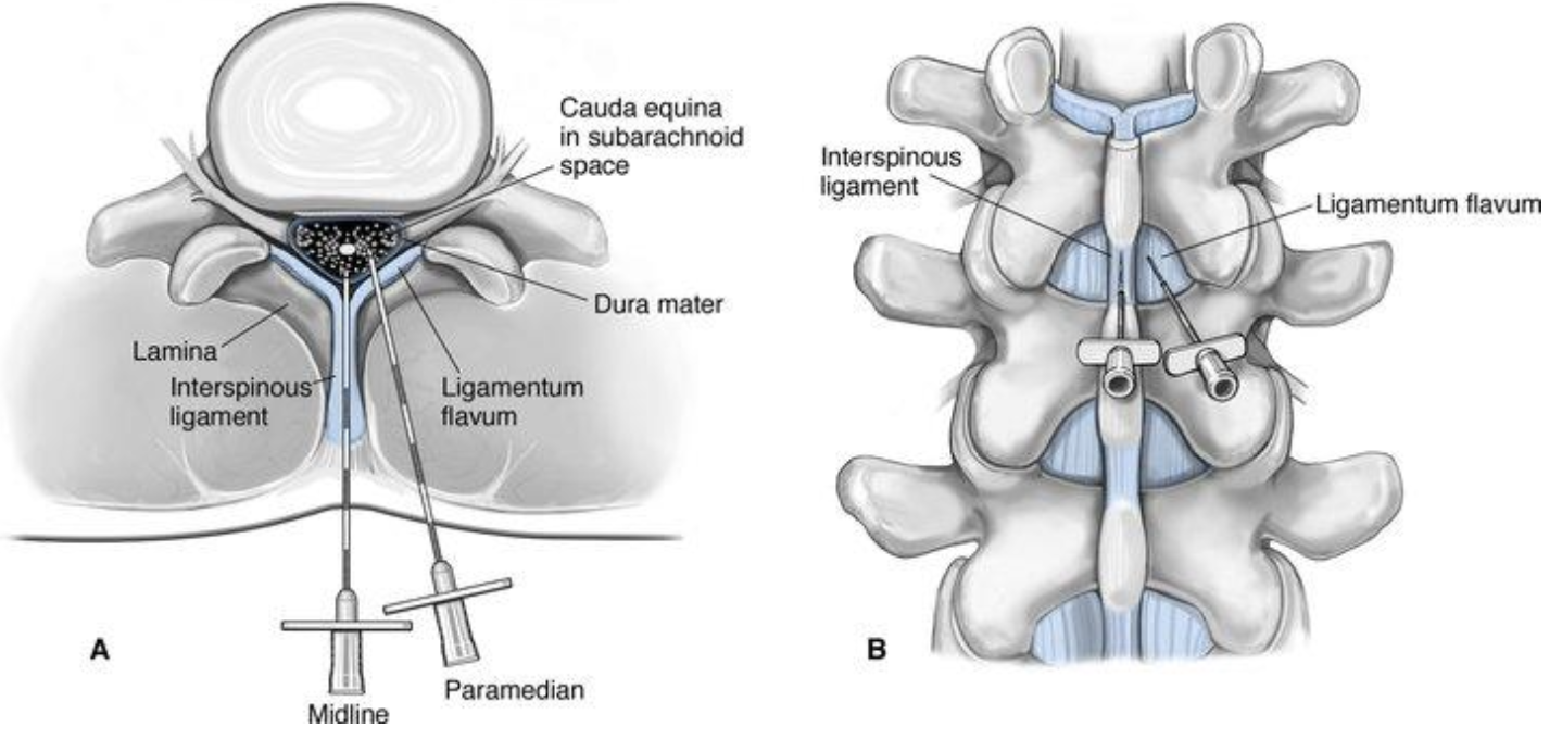 <p>Skin, subcutaneous tissue, ligamentum flavum, epidural space, dura mater, arachnoid mater, and subarachnoid space</p>