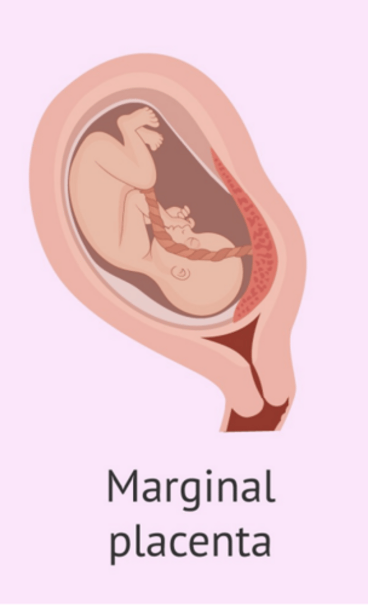 <p>Placenta edge within 2cm of the internal os without covering it</p>
