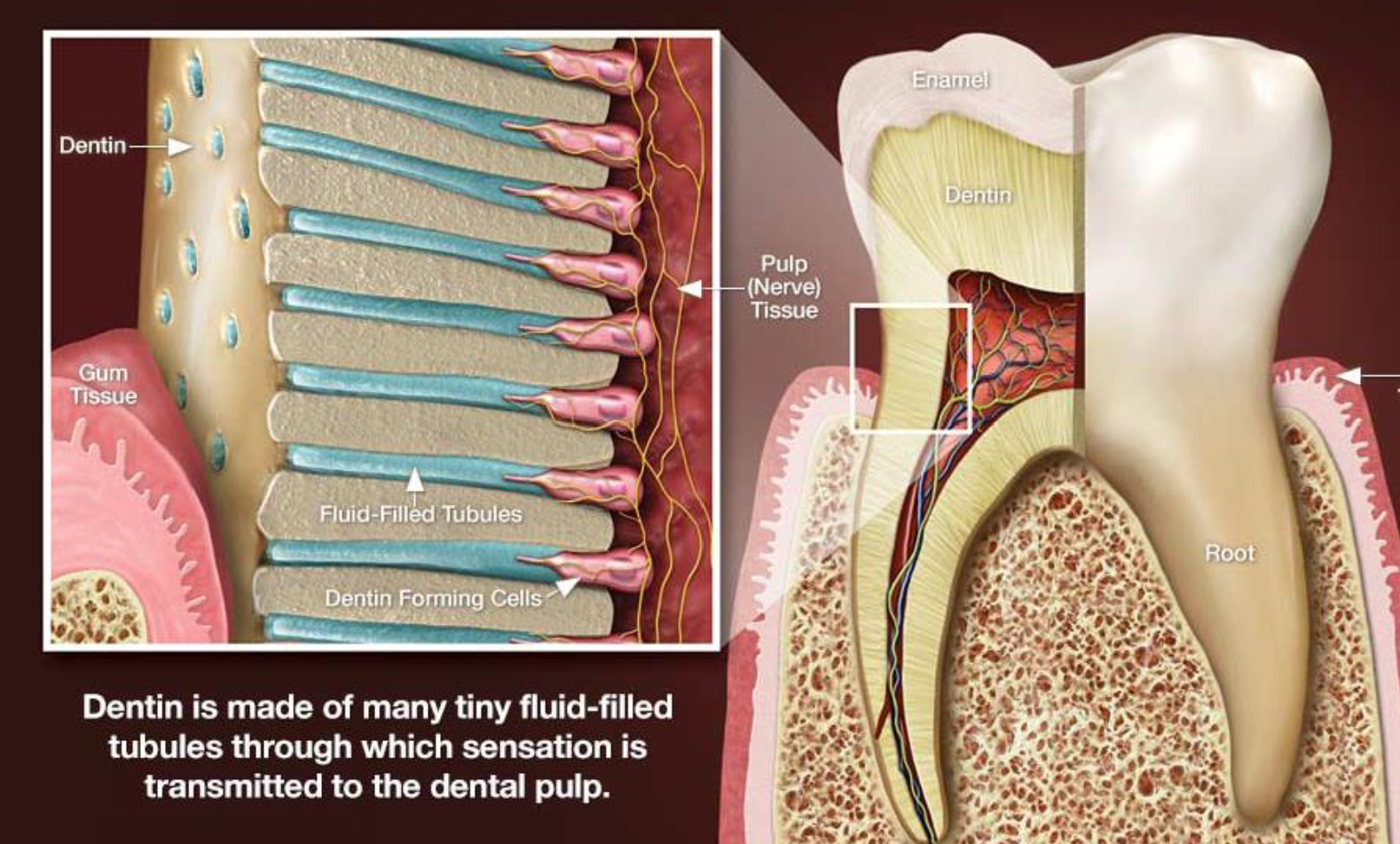 <p>Inflammation→ </p><p>Swelling of odontoblasts→ </p><p>Occlude dentinal tubules→ </p><p>Increased pressure and sensitivity to fluid movements in the tubules</p>