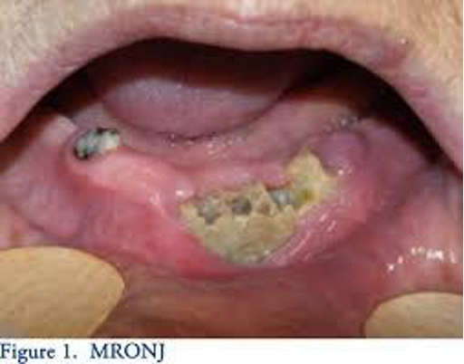 <p>CASE: A patient has exposed jaw bone (or a fistula that probes to bone) but has no pain, erythema, or infection. Which MRONJ stage is this?</p>