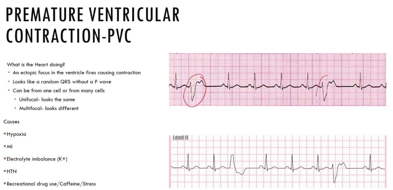 <p>premature ventricular contraction-pvc</p>